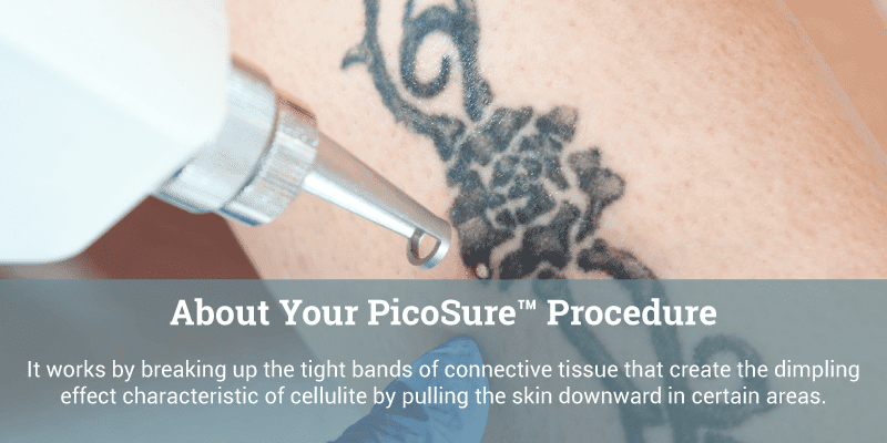 PicoSure Laser Tattoo Removal - Barber Surgeons Guild®