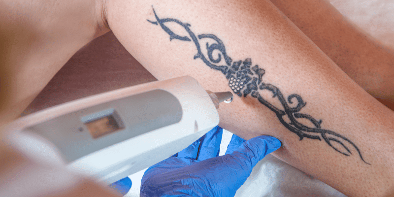 The Science Behind Laser Tattoo Removal - Dr. Pimple Popper