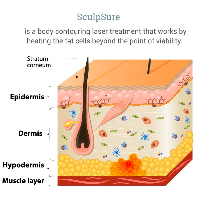 CoolSculpting Vs Sculpsure: What is the difference? - The Cosmetic Skin  Clinic